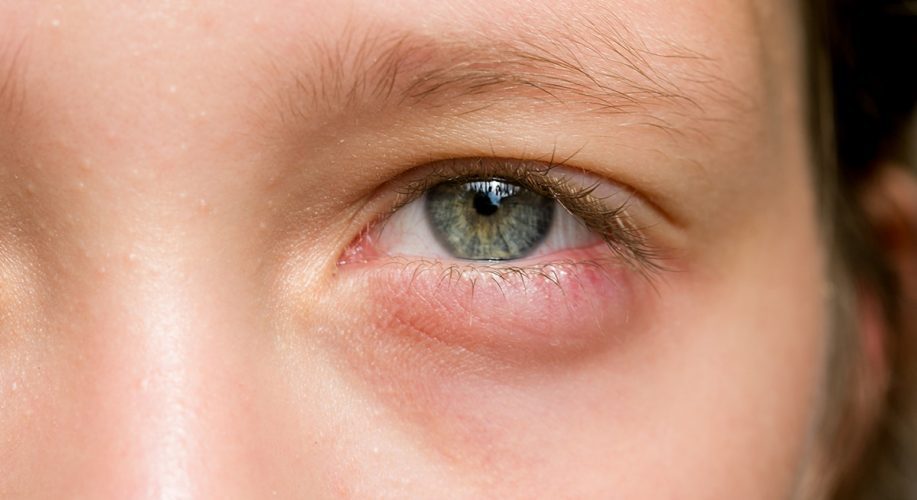 swollen-eyelid-symptoms-treatment-pictures-causes-hubpages